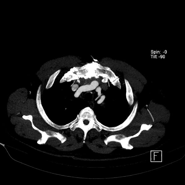 File:Aortic dissection - De Bakey type III - Stanford B (Radiopaedia 21903-21882 B 12).jpg