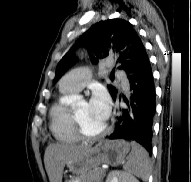 File:Aortic dissection - Stanford type A (Radiopaedia 29247-29659 C 16).jpg