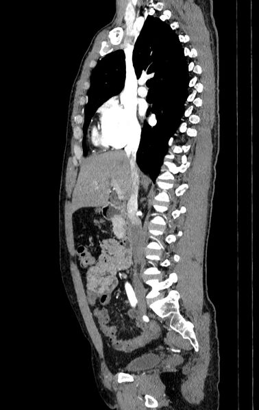 File:Aortic dissection - Stanford type A (Radiopaedia 83418-98500 B 16).jpg