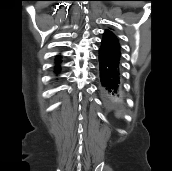 File:Aortic dissection with rupture into pericardium (Radiopaedia 12384-12647 B 40).jpg