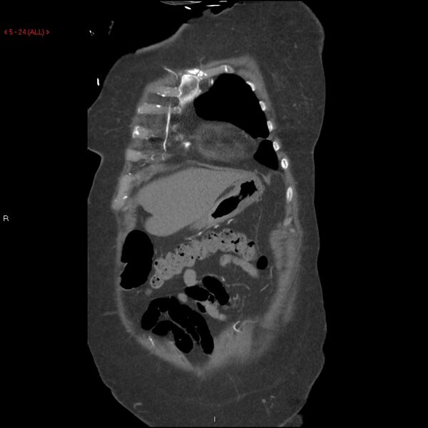 File:Aortic intramural hematoma (Radiopaedia 27746-28001 B 1).jpg