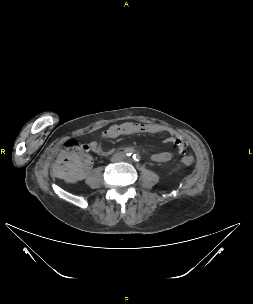 Aortoenteric fistula (Radiopaedia 84308-99603 Axial non-contrast 228).jpg