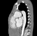 Aortopulmonary window, interrupted aortic arch and large PDA giving the descending aorta (Radiopaedia 35573-37074 C 24).jpg