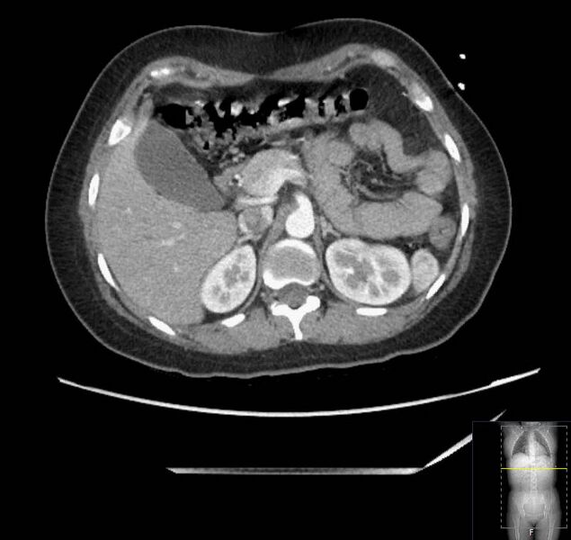 File:Appendicitis (CT angiogram) (Radiopaedia 154713-127660 Axial 144).jpg