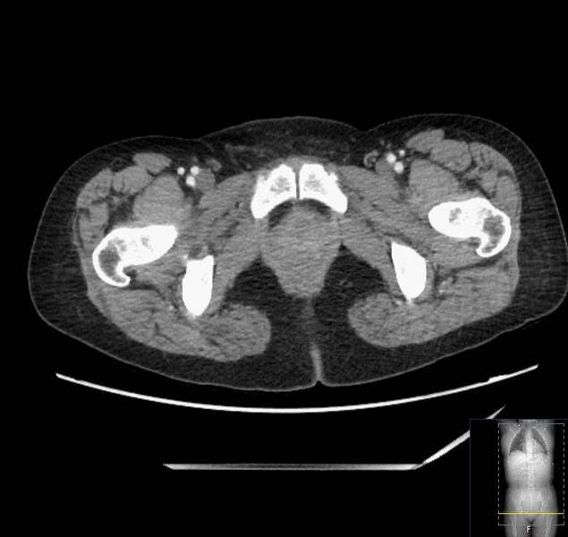 File:Appendicitis (CT angiogram) (Radiopaedia 154713-127660 Axial 88).jpg
