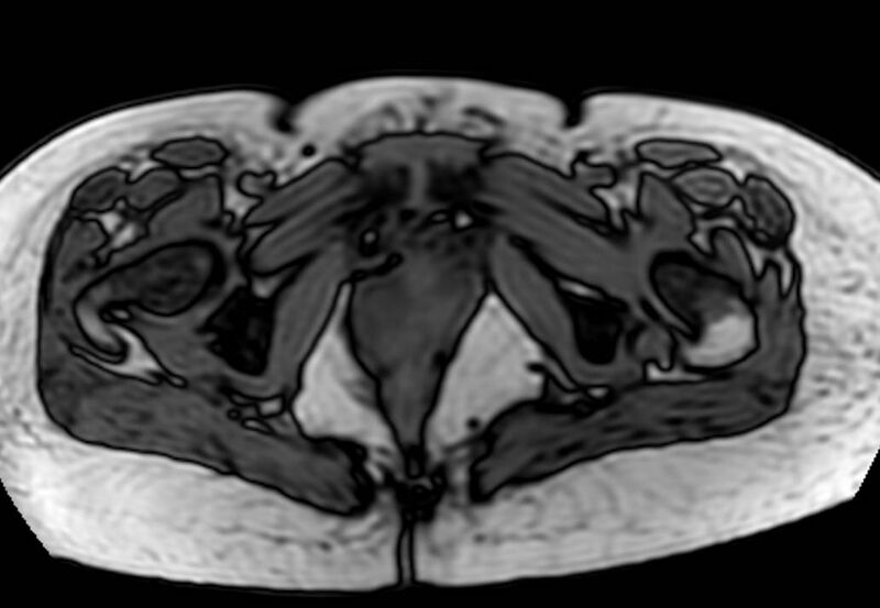 File:Appendicitis in gravida (MRI) (Radiopaedia 89433-106395 D 70).jpg
