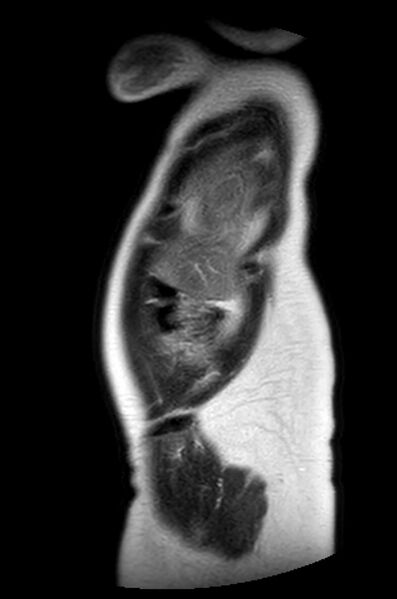 File:Appendicitis in gravida (MRI) (Radiopaedia 89433-106395 Sagittal T2 60).jpg