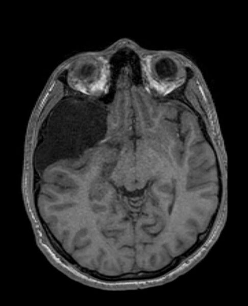 File:Arachnoid cyst- extremely large (Radiopaedia 68741-78451 Axial T1 34).jpg