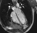 Arrhythmogenic right ventricular cardiomyopathy (Radiopaedia 39806-42237 D 97).jpg