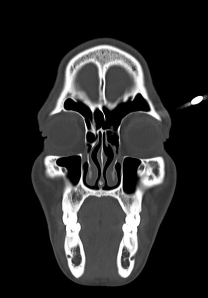 File:Arrow injury to the head (Radiopaedia 75266-86388 Coronal bone window 23).jpg