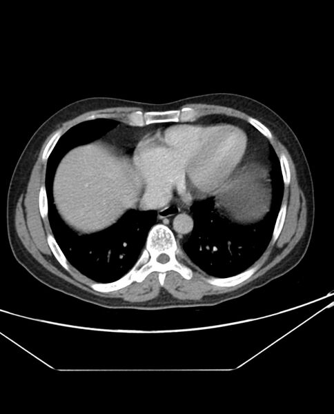 File:Arterial occlusive mesenteric ischemia (Radiopaedia 84641-100054 A 6).jpg
