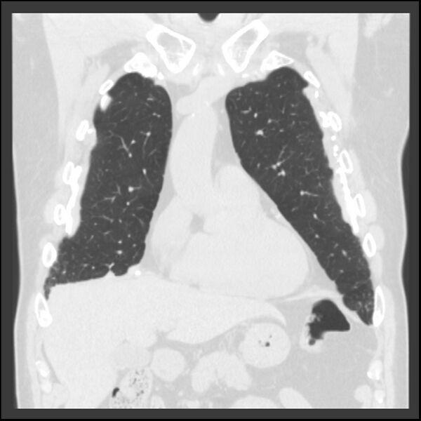 File:Asbestos-related pleural plaques (Radiopaedia 39069-41255 Coronal lung window 65).jpg
