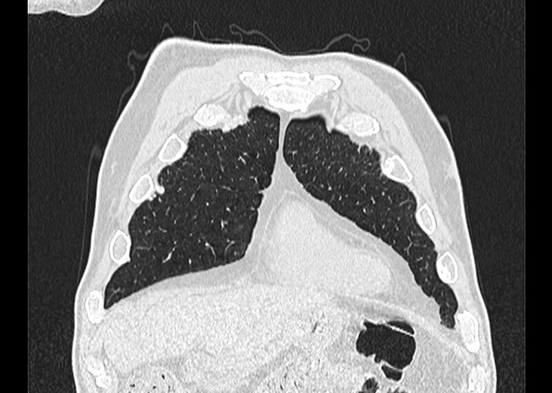 File:Asbestos pleural placques (Radiopaedia 57905-64872 Coronal lung window 36).jpg