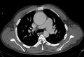Ascending aortic aneurysm (Radiopaedia 86279-102297 C 20).jpg