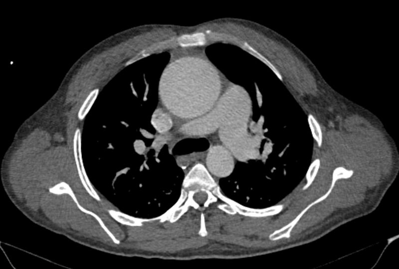 File:Ascending aortic aneurysm (Radiopaedia 86279-102297 C 20).jpg