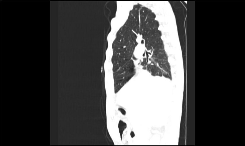 File:Aspergilloma (Radiopaedia 20788-20701 Sagittal lung window 13).jpg