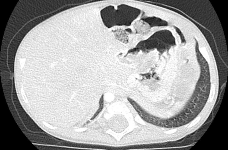 File:Asplenia syndrome (Radiopaedia 73083-83792 Axial lung window 72).jpg