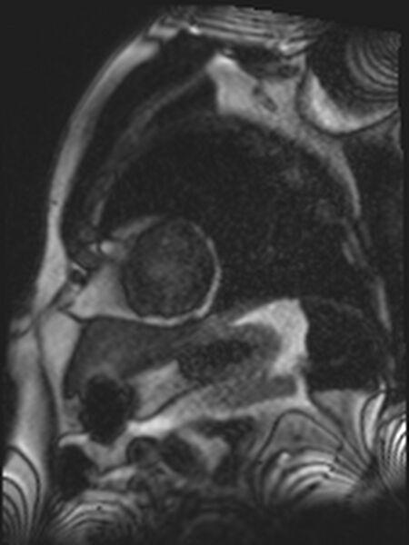 File:Asymmetric septal hypertrophic cardiomyopathy - systolic anterior motion of mitral leaflet (Radiopaedia 72795-83445 E 8).jpg