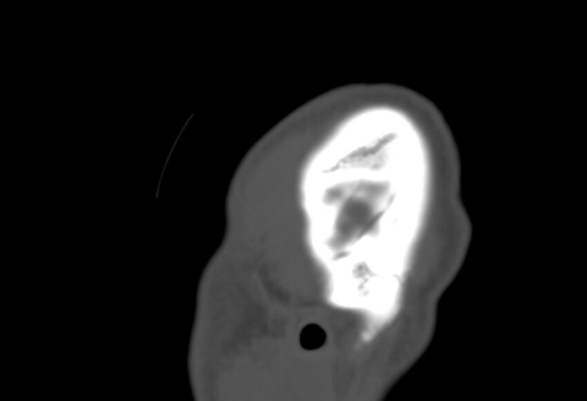 Asymptomatic occipital spur (Radiopaedia 87753-104201 Sagittal bone window 307).jpg