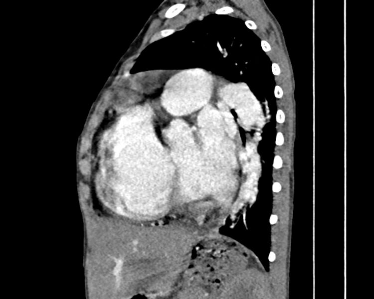 File:Atrial septal defect complicated by Eisenmenger syndrome (Radiopaedia 53707-59768 Sagittal C+ CTPA 19).jpg