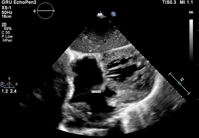 File:Atrial septal defect with pulmonary hypertension (Radiopaedia 48742-53755 A 1).JPG