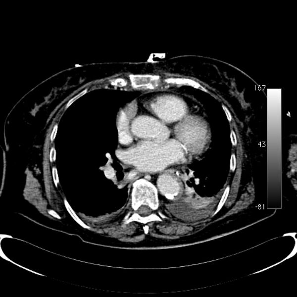 File:Atypical dissection of the thoracic aorta (Radiopaedia 10975-78320 A 39).jpg