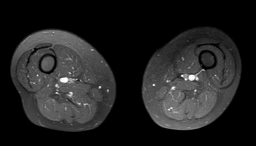 Atypical lipomatous tumor - thigh (Radiopaedia 68975-78734 Axial PD fat sat 39).jpg