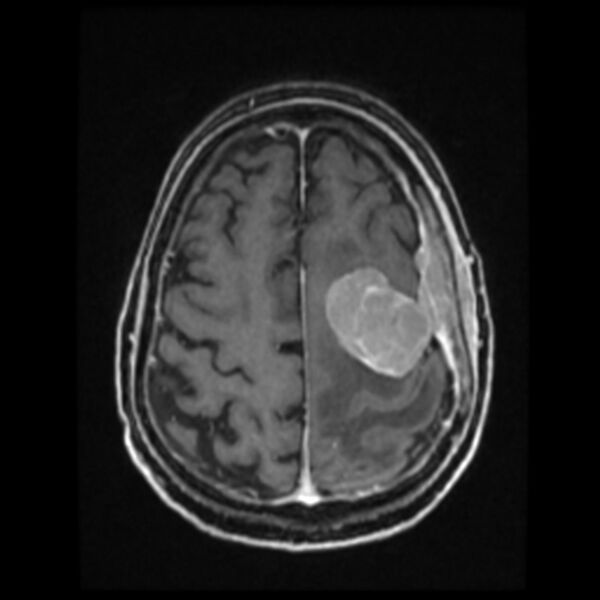 File:Atypical meningioma (Radiopaedia 45535-49629 Axial T1 C+ 52).jpg