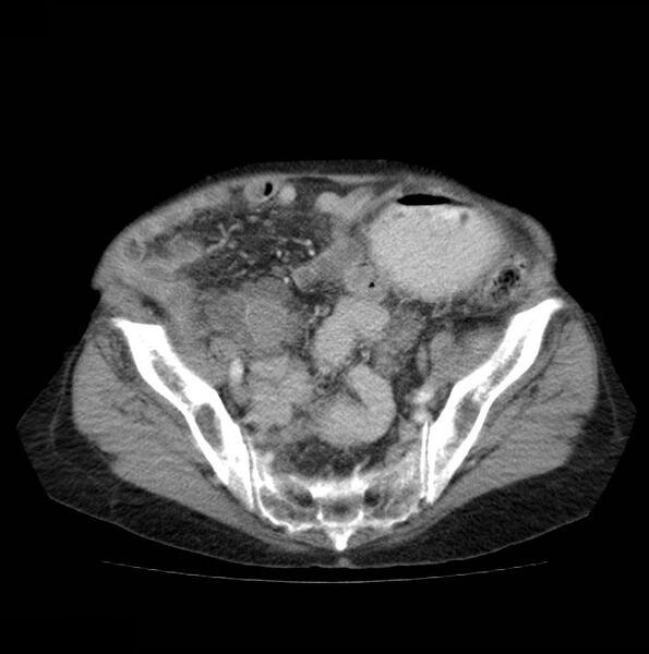 File:Autosomal dominant polycystic kidney disease (Radiopaedia 16777-16490 A 46).jpg