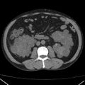 Autosomal dominant polycystic kidney disease (Radiopaedia 36539-38101 Axial non-contrast 42).jpg
