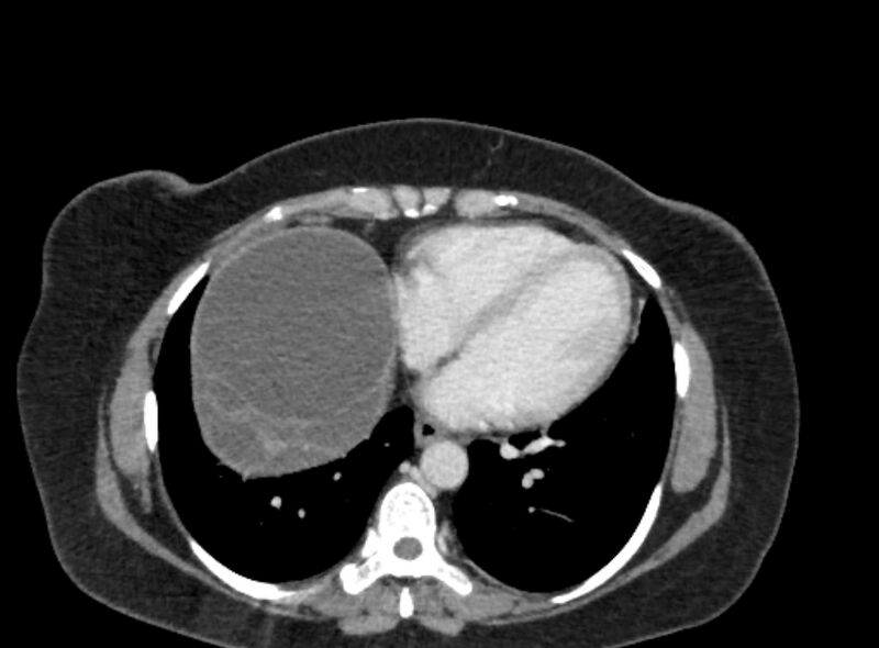 File:Autosomal dominant polycystic kidney disease (Radiopaedia 57124-64017 A 11).jpg
