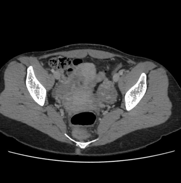 File:Autosomal dominant polycystic kidney disease - early onset (Radiopaedia 40734-43387 A 73).jpg