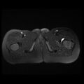 Avascular necrosis of the hip (Radiopaedia 29563-30067 Axial T2 fat sat 17).jpg