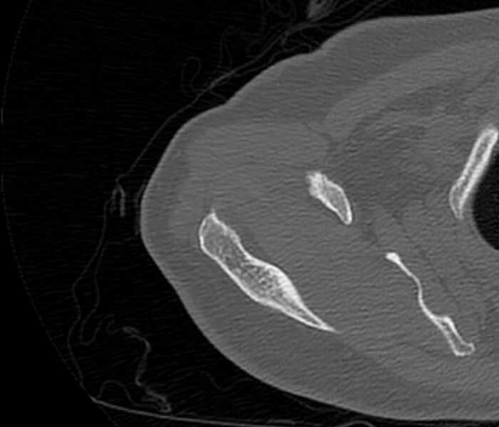 File:Avulsion fracture - greater tuberosity of humerus (Radiopaedia 71216-81514 Axial bone window 19).jpg