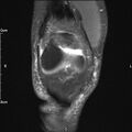 Avulsion fracture of the fibular head (Radiopaedia 74804-85808 Coronal PD fat sat 10).jpg