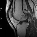 Avulsion fracture of the fibular head (Radiopaedia 74804-85808 D 20).jpg