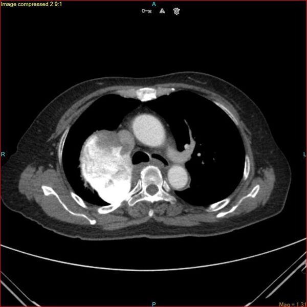 File:Azygos vein aneurysm (Radiopaedia 77824-90130 B 24).jpg