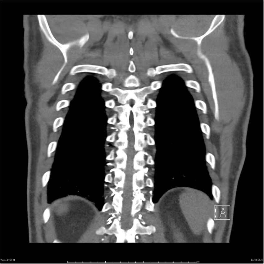 Azygos venous system anatomy (CT pulmonary angiography) (Radiopaedia 25928-26077 Coronal C+ CTPA 67).jpg