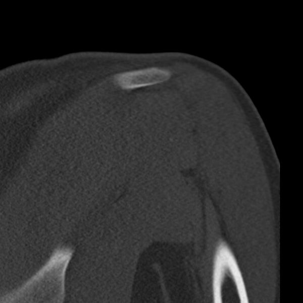 File:Bankart lesion (Radiopaedia 22771-22798 Coronal bone window 37).jpg