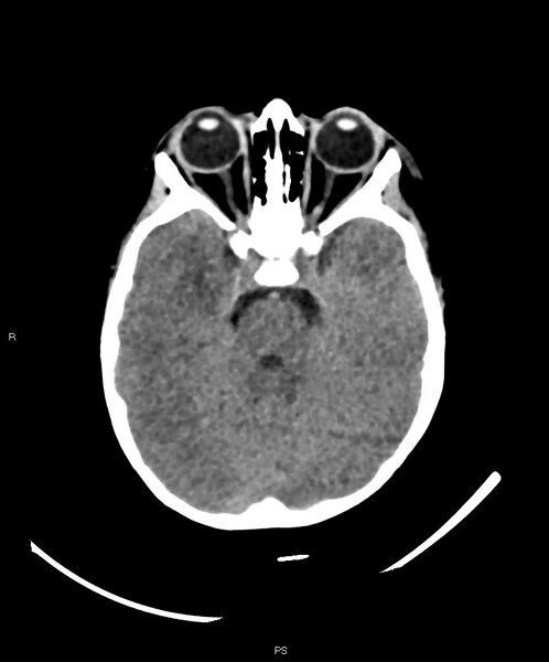 File:Basal ganglia and parenchymal ischemia (Radiopaedia 45818-50083 Axial non-contrast 31).jpg