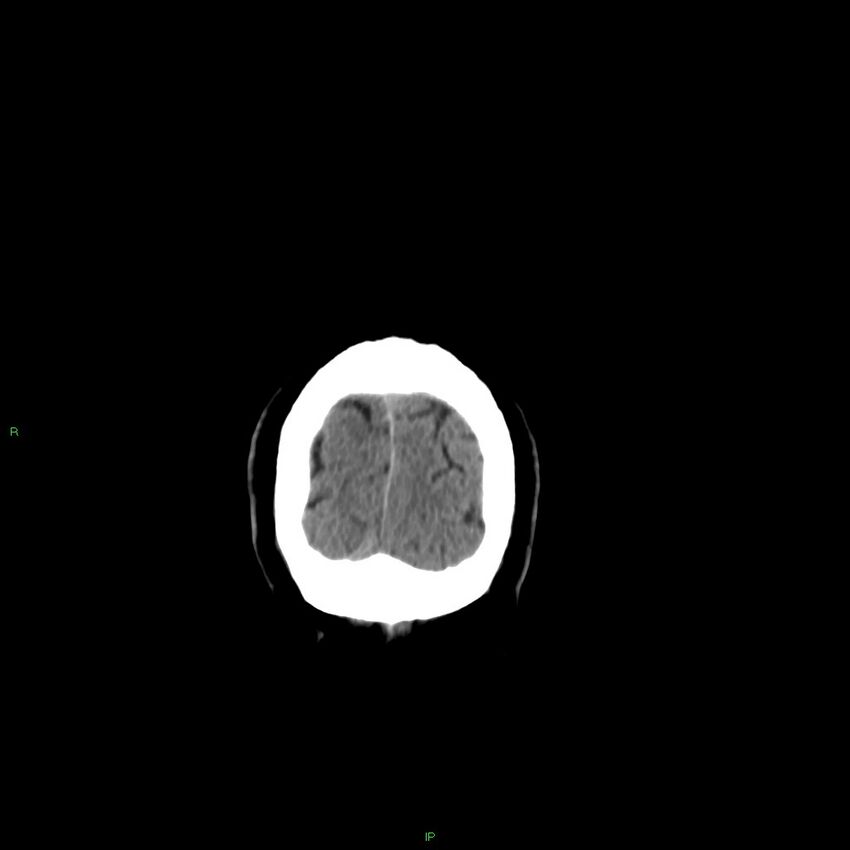 Basal ganglia hemorrhage (Radiopaedia 58346-65467 Coronal non-contrast 20).jpg