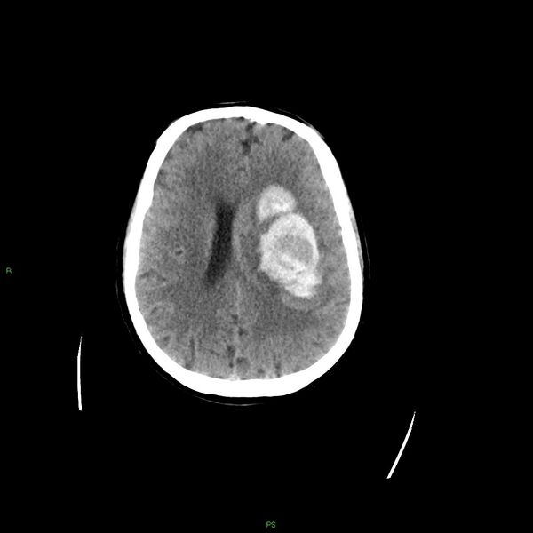 File:Basal ganglia hemorrhage (Radiopaedia 58349-65472 Axial non-contrast 24).jpg