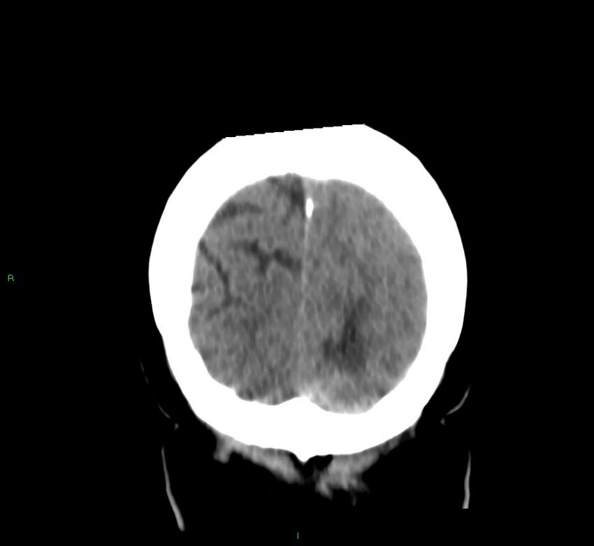 Basal ganglia hemorrhage (Radiopaedia 58759-65981 Coronal non-contrast 15).jpg