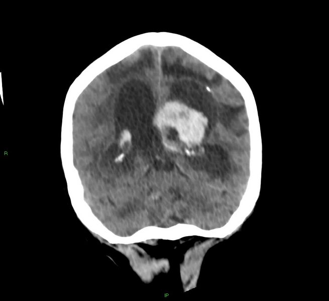 File:Basal ganglia hemorrhage (Radiopaedia 58766-65988 Coronal non-contrast 25).jpg