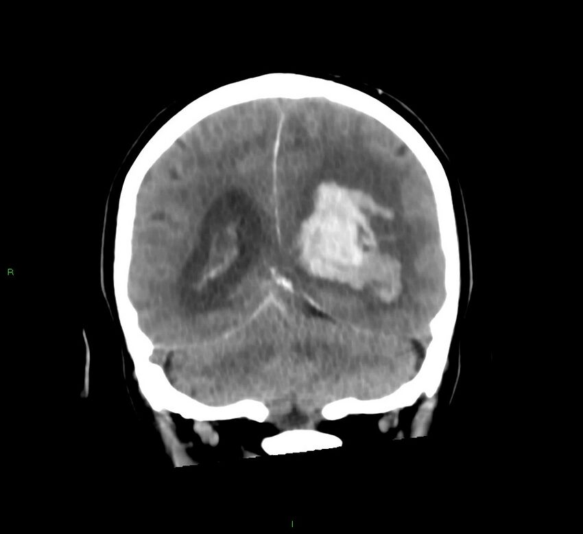 Basal ganglia hemorrhage (Radiopaedia 58775-66008 Coronal non-contrast 24).jpg