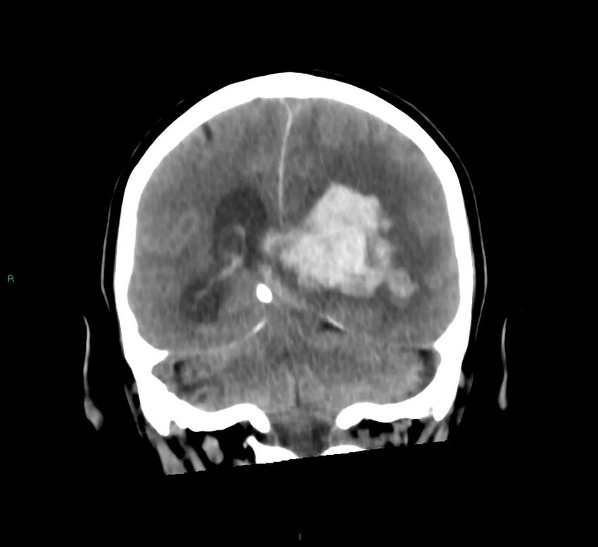 Basal ganglia hemorrhage (Radiopaedia 58775-66008 Coronal non-contrast 26).jpg