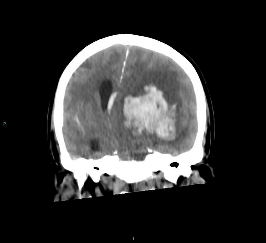 Basal ganglia hemorrhage (Radiopaedia 58775-66008 Coronal non-contrast 36).jpg