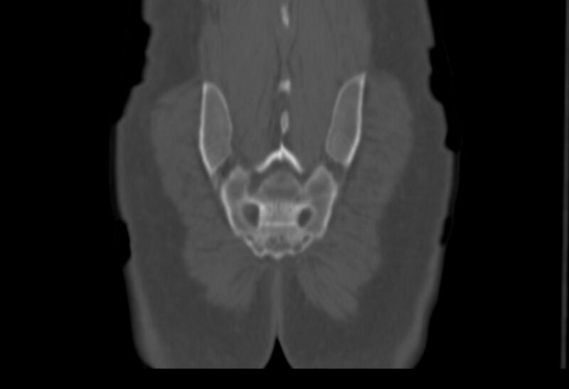 File:Bertolotti syndrome (Radiopaedia 58974-66235 Coronal bone window 2).jpg