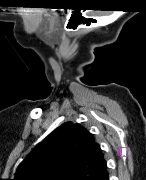 File:Bilateral atlanto-occipital assimilation (Radiopaedia 28350-28603 D 2).jpg