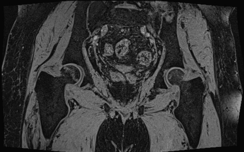 Bilateral avascular necrosis of femoral head (Radiopaedia 77116-89078 Coronal T2 we 21).jpg